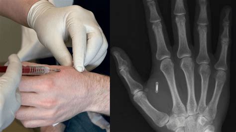 implantable rfid chip manufacturers|how to disable microchip implants.